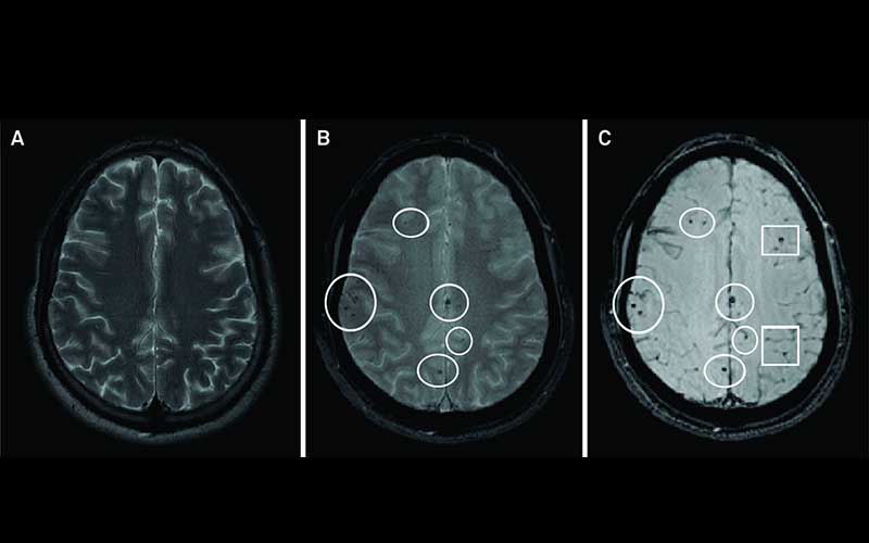 Pengertian Diffuse Axonal Injury, Kasus Penganiayaan Mario Dandy Satrio