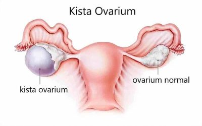 Viral, Apa Benar Makanan Pedas Jadi Penyebab Kista? Ciri-ciri Kista Ovarium, Termasuk Kembung dan Sering Buang Air