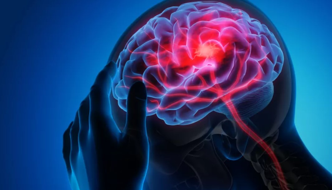 Apa-yang-Menyebabkan-Terjadinya-Penyakit-Stroke
