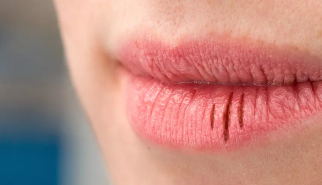 Penyebab-Bibir-Kering-dan-Mengelupas