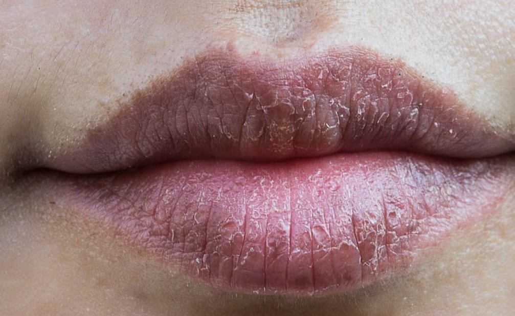 Produk-Terbaik-untuk-Mengatasi-Bibir-Kering-dan-Mengelupas