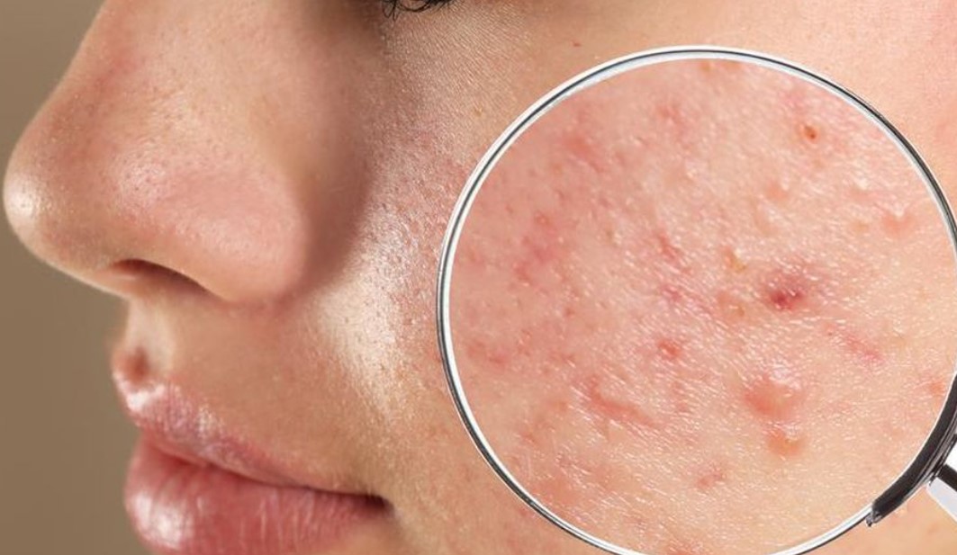 Rekomendasi-Produk-Masker-Alami-untuk-Menghilangkan-Jerawat-dan-Bekasnya