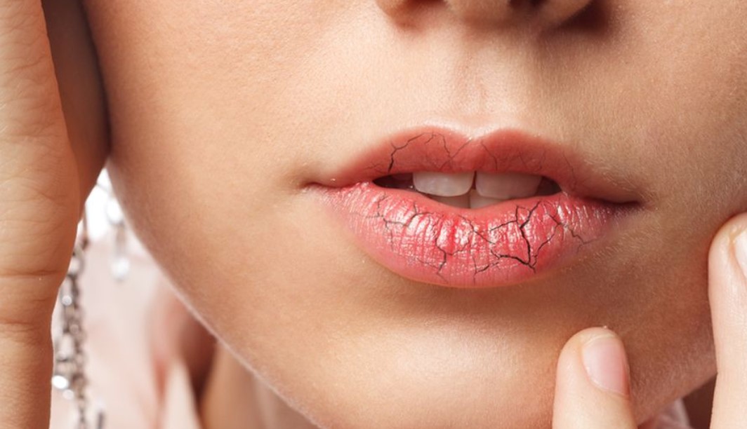 Solusi-Praktis-untuk-Mengatasi-Bibir-Kering-dan-Mengelupas