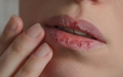 Cara Mengatasi Bibir Kering dan Mengelupas: Solusi Efektif untuk Bibir Sehat dan Lembut