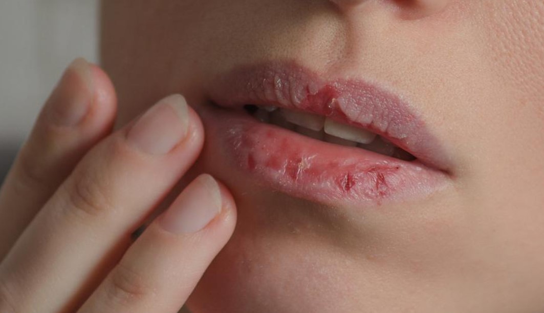 Cara Mengatasi Bibir Kering dan Mengelupas: Solusi Efektif untuk Bibir Sehat dan Lembut